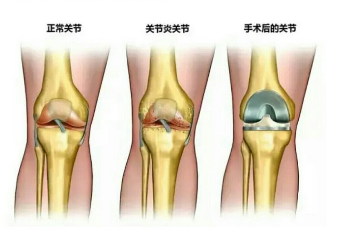 膝关节炎与膝关节表面置换术