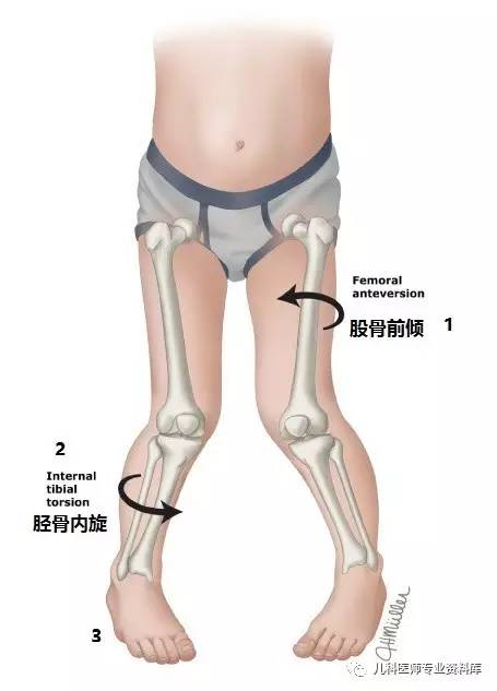 儿童内八字脚