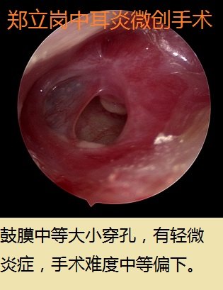 慢性化脓性中耳炎耳内镜微创手术第415广东云