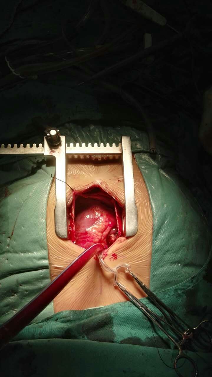 成人胸骨下段切口体外循环下心脏直视手术!心脏疾病胸骨下段切口