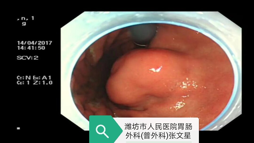 潍坊市人民医院胃肠外科(普外科)内镜技术为患