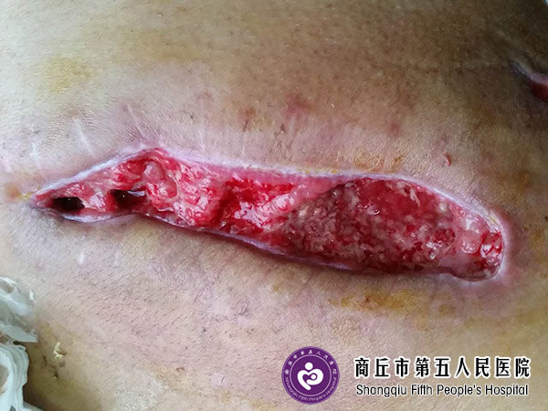 难愈合创面:手术后刀口不愈合导致难愈合创面