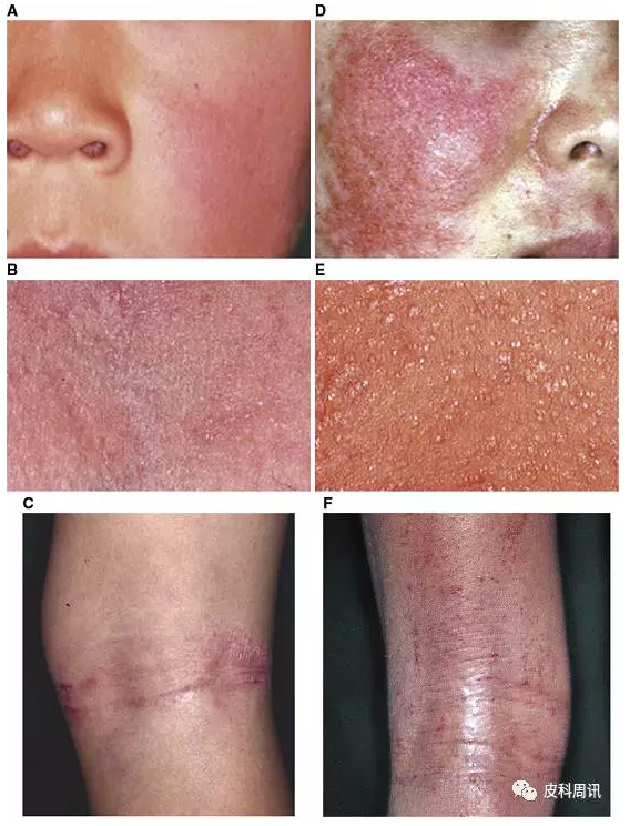 2017 jsa指南:特应性皮炎(一)