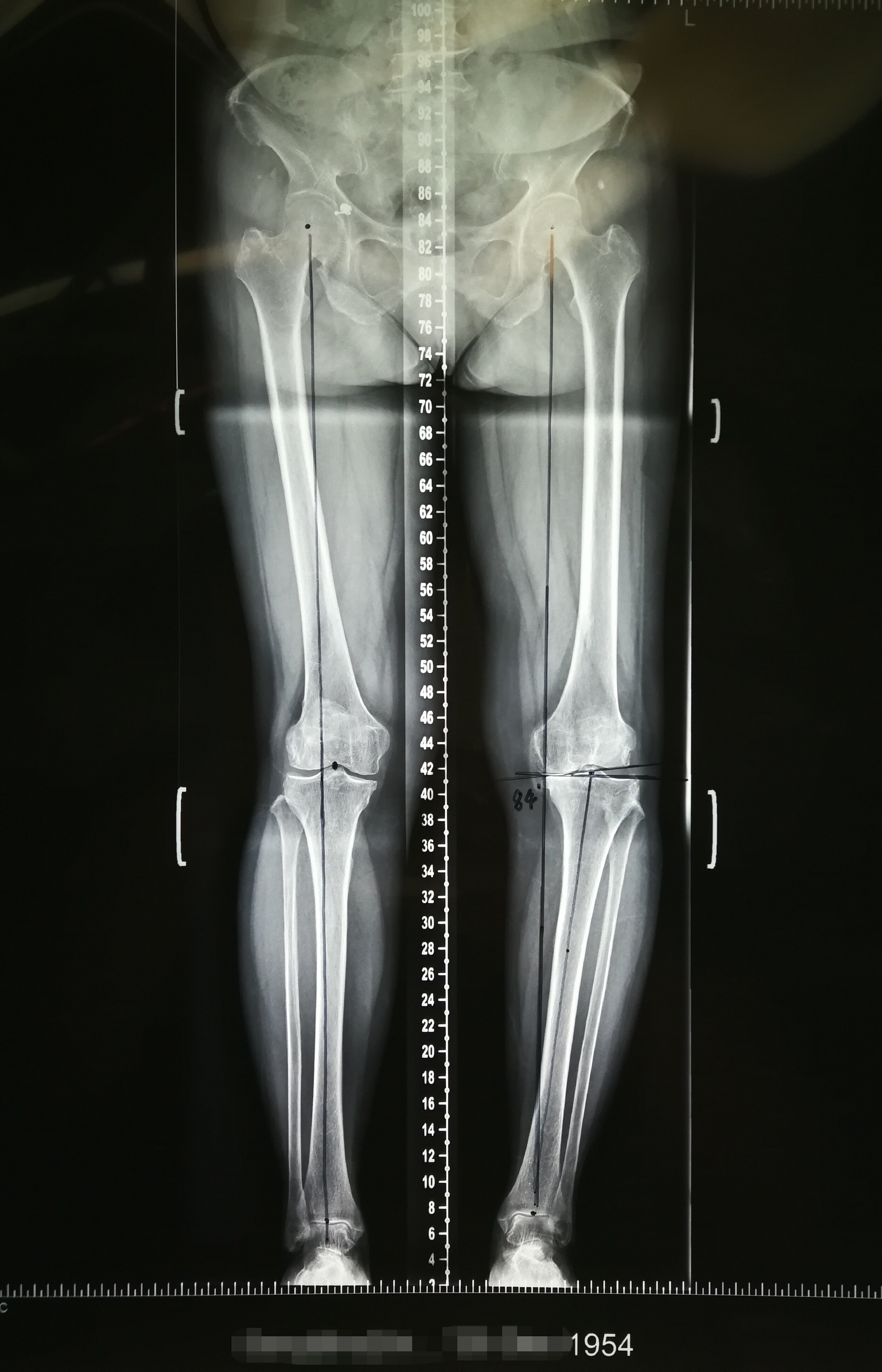 63岁女性,膝关节骨性关节炎,胫骨近端高位截骨术.