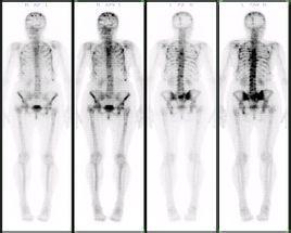 1513502431522428.jpg 骨扫描.jpg