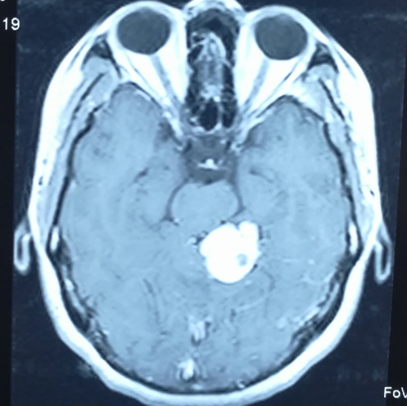 小脑血管母细胞瘤顺利 - 好大夫在线