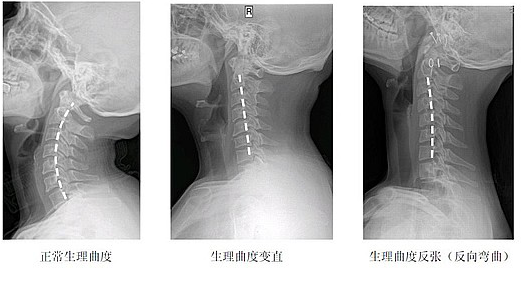 颈椎曲度变直(颈椎反曲)就是颈椎病吗?_颈椎病