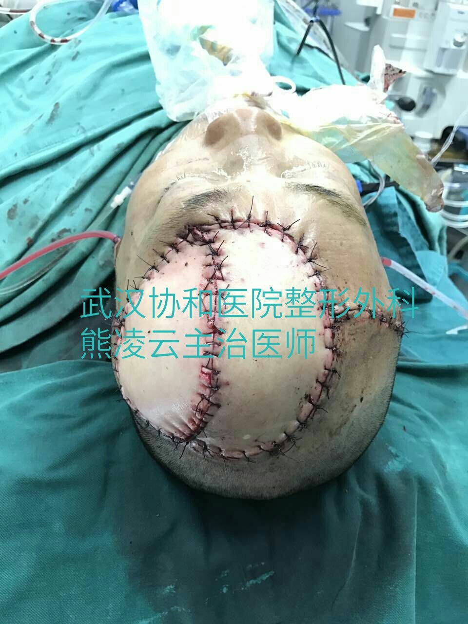 多次复发隆突性皮肤纤维肉瘤的治疗:武汉协和