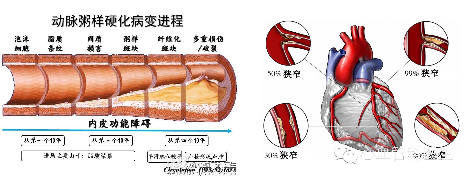图1 图解冠心病