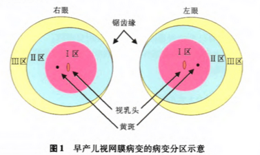 早产儿视网膜病变