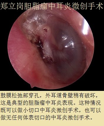 胆脂瘤中耳炎小切口微创手术第437湖北荆门京