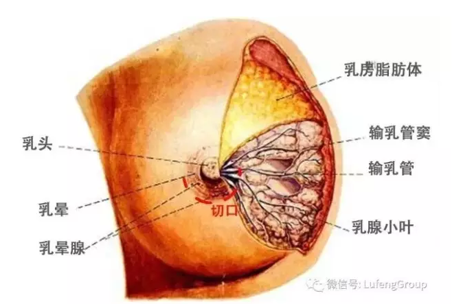 今天我们就来说说乳房这点事儿  乳晕缘切口示意图