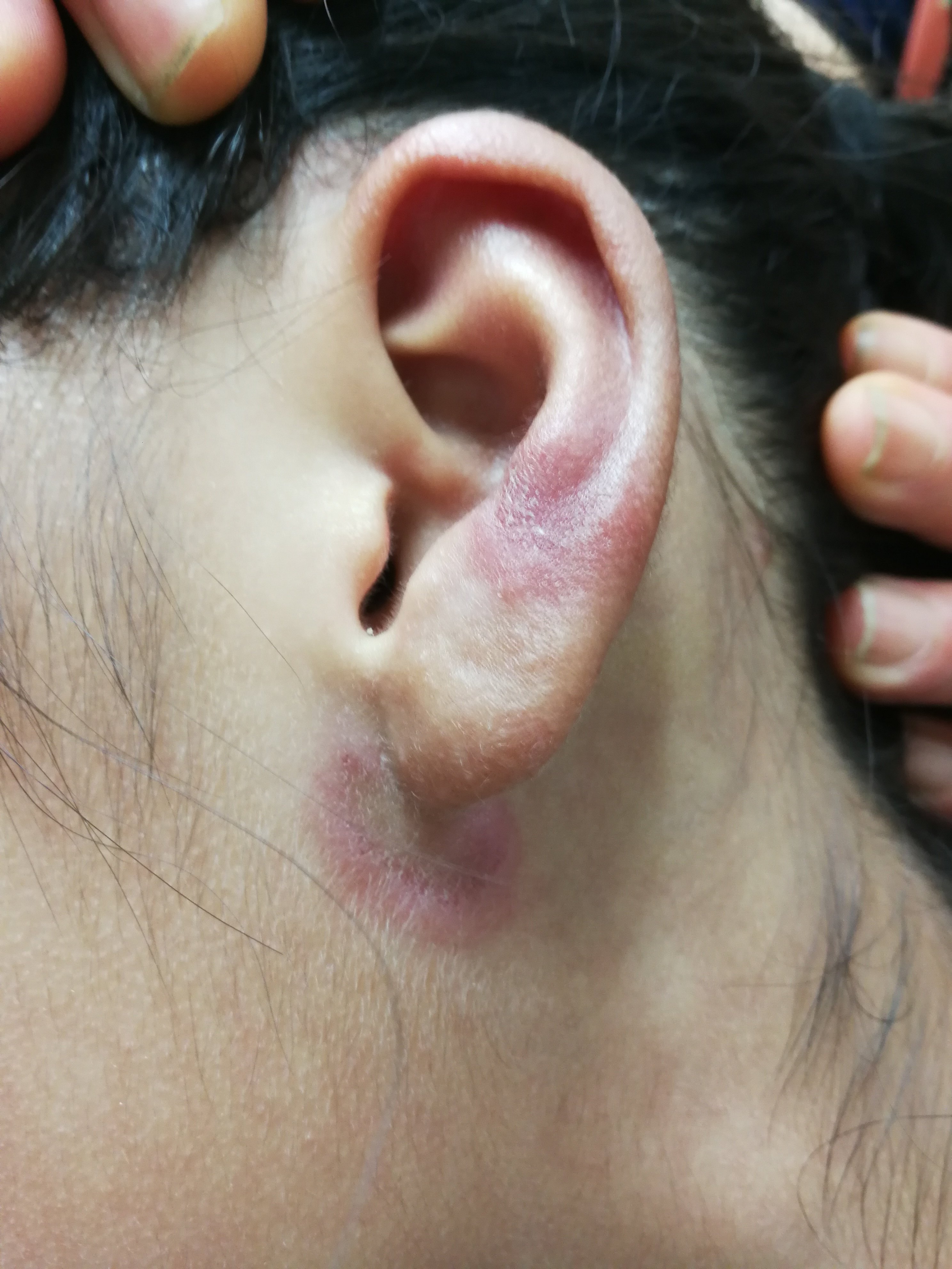 红斑狼疮皮疹表现展示 (原创)