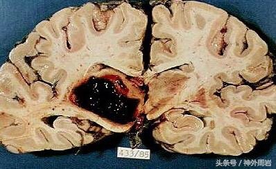引起脑出血的原因难道只有高血压吗? - 好大夫