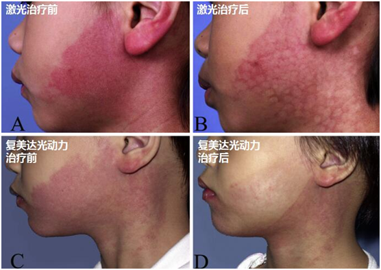 治疗鲜红斑痣:海姆泊芬光动力与脉冲染料激光