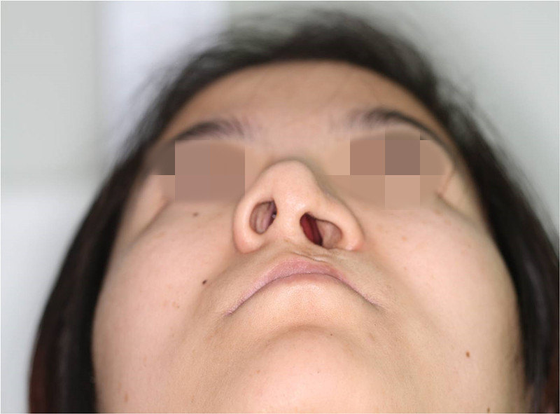 唇裂鼻畸形术前术后四面观对比效果图