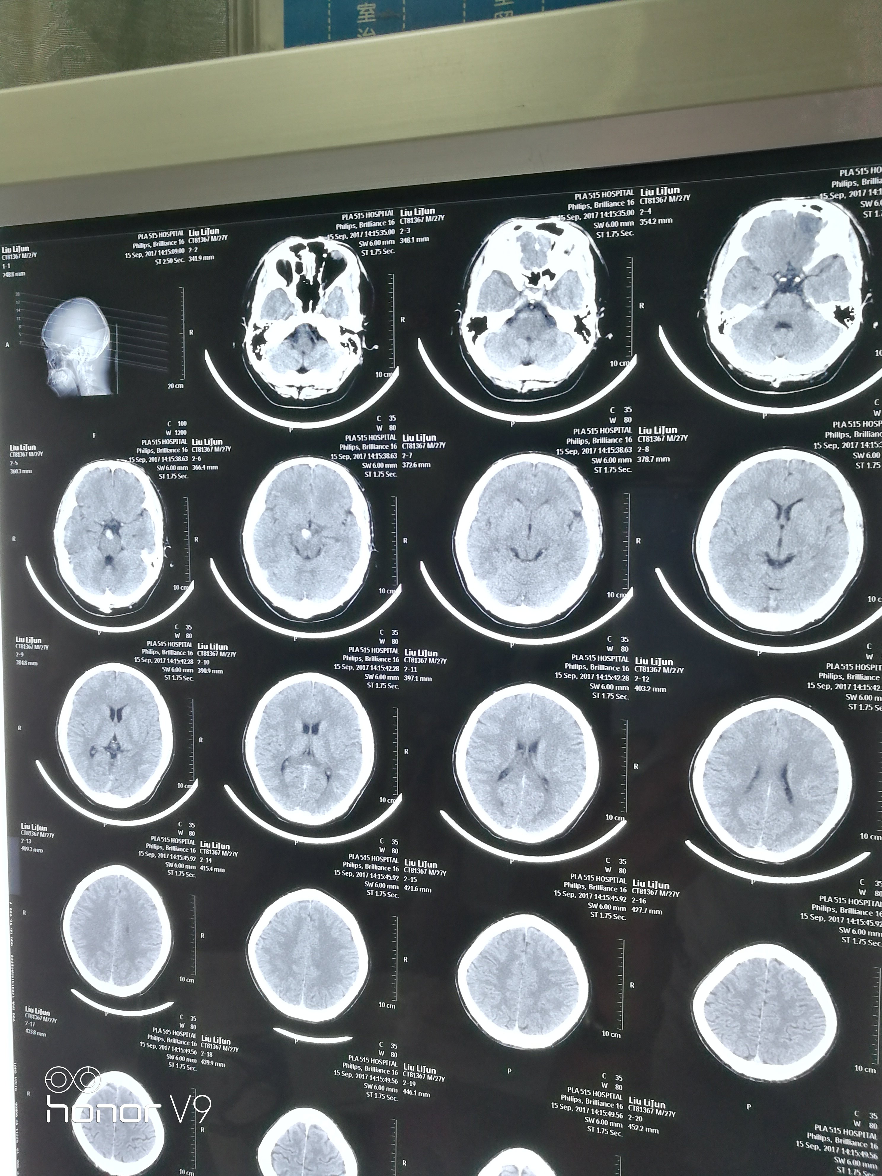 此患者表现为眼睑下垂,视物重影,ct表现为右侧脚间池占位