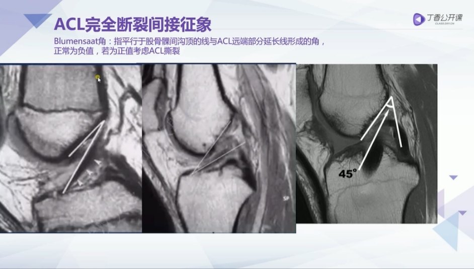 肌腱韧带损伤前交叉韧带损伤mri上7大征象