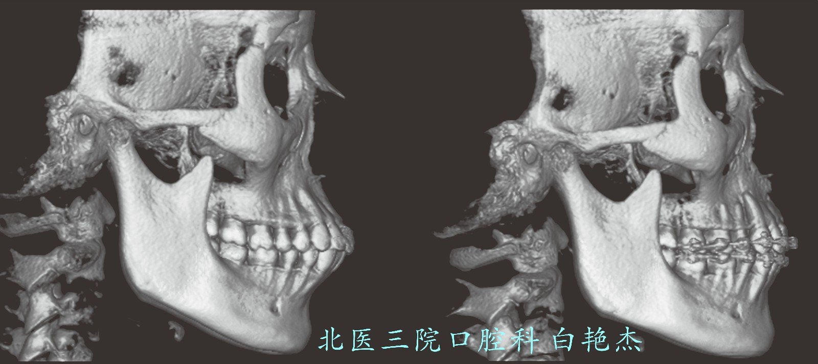 尹国香-CBCT-201705-科普.jpg