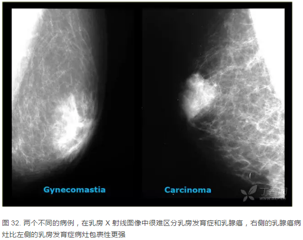 男性乳腺恶性肿瘤少见类型