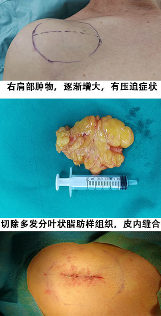 皮脂腺囊肿(粉瘤)、脂肪瘤、淋巴结的鉴别及正