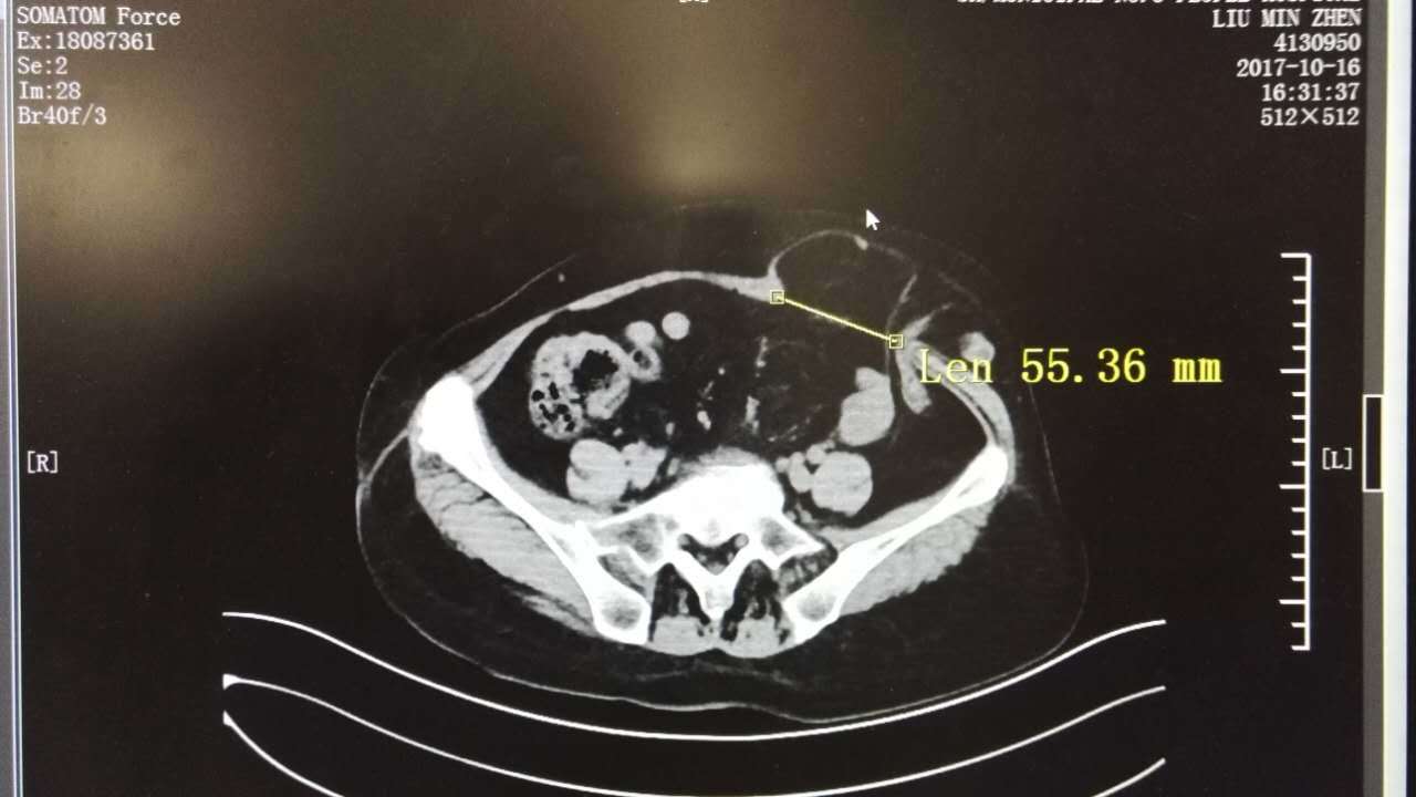 樊友本 造口旁疝治疗经验分享 最近连续为多例 直肠癌 术后造口旁疝