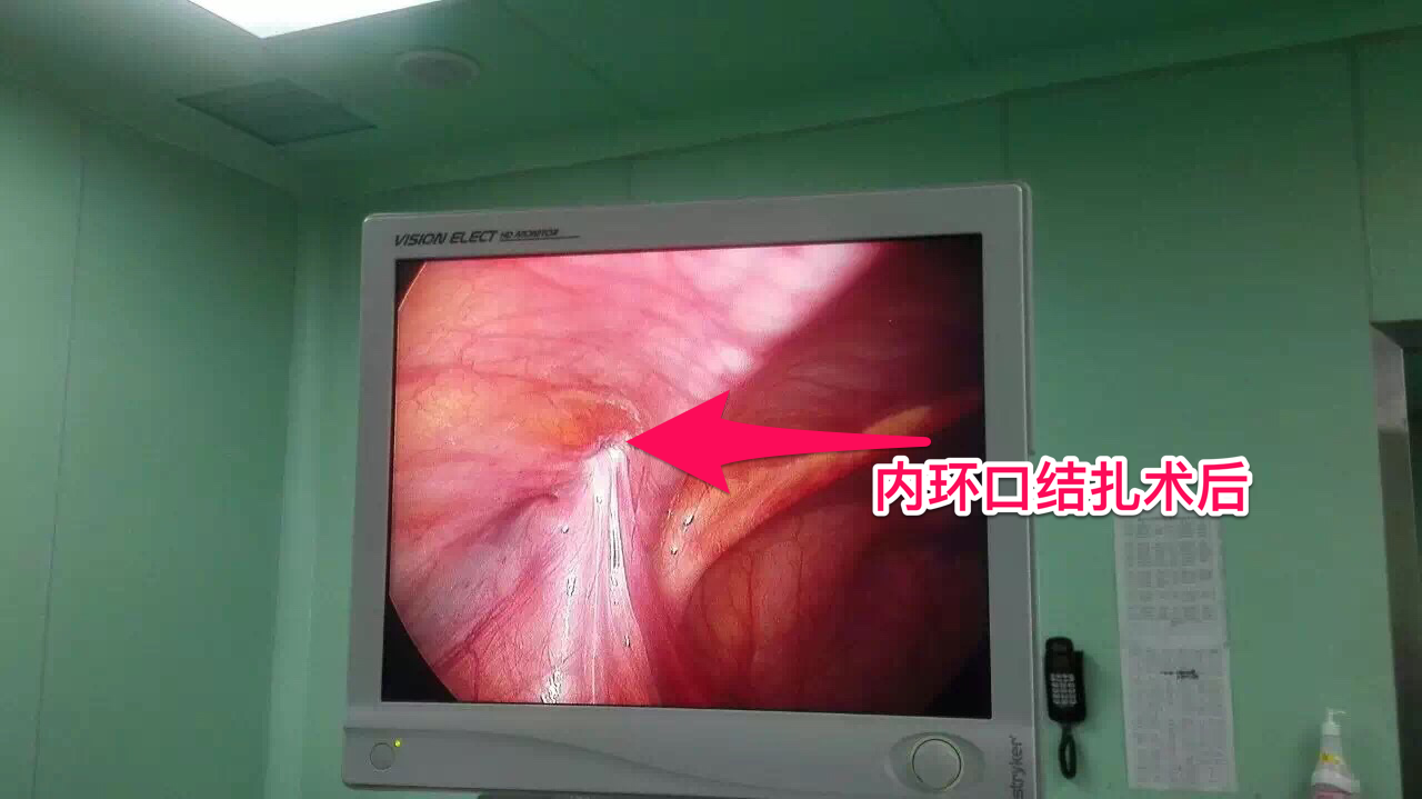腹腔镜微创治疗复发性腹股沟斜疝(第一次手术