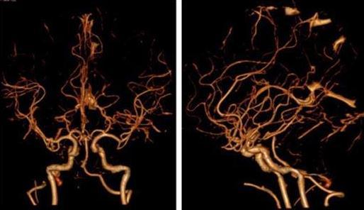 几种脑血管造影方法dsactamra的比较