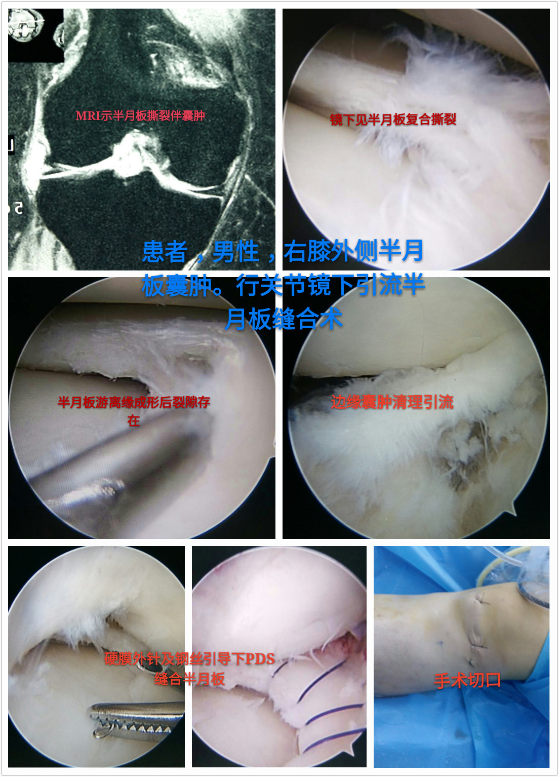 半月板囊肿关节镜下清除半月板缝合术