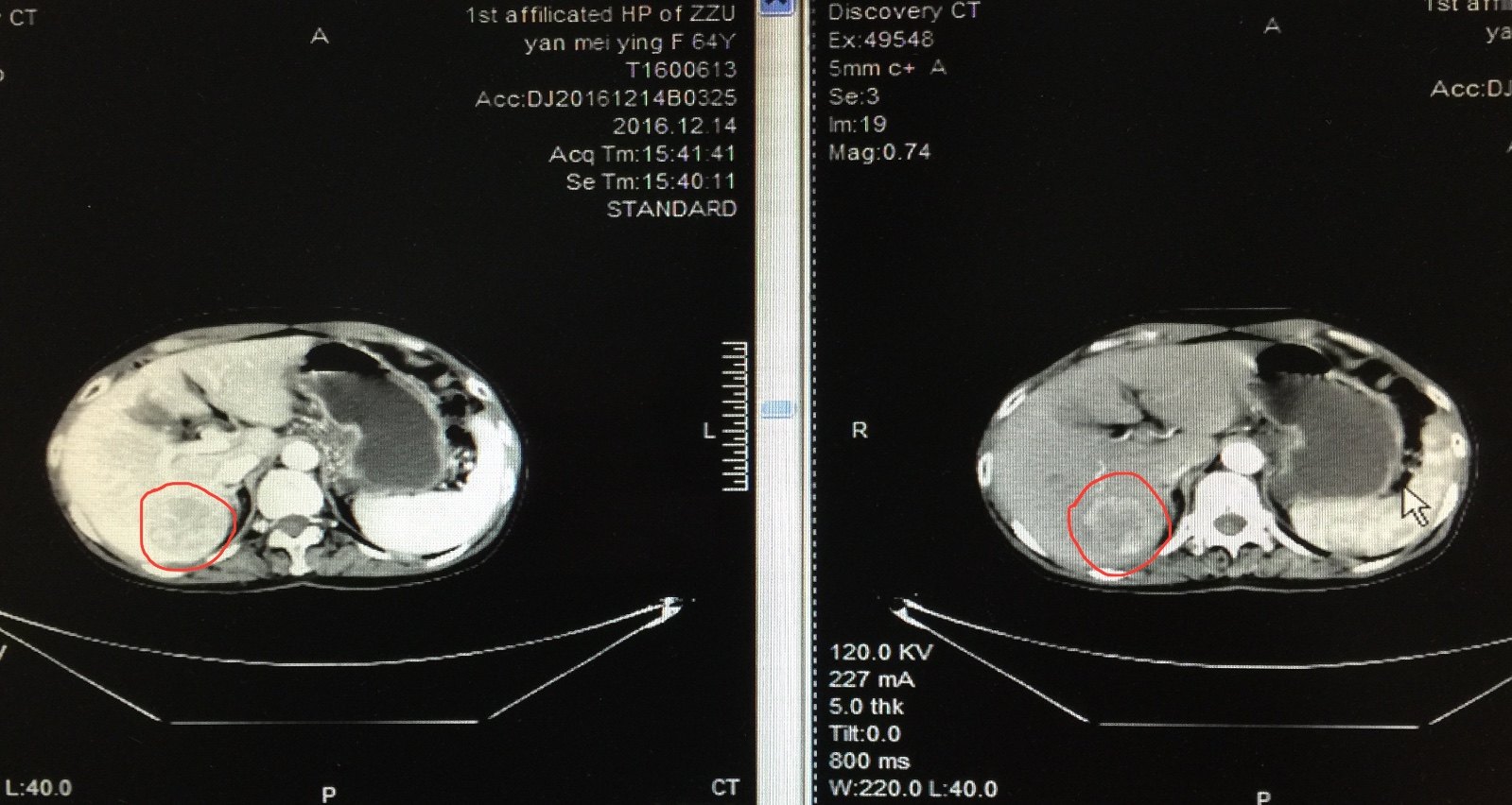 第三节 左半肝切除术-肿瘤外科手术-医学