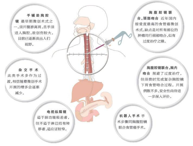 食管癌的手术是怎么做的