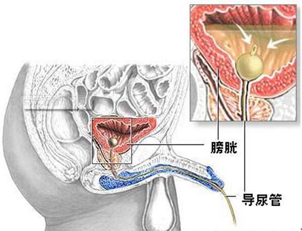 1497517197872539.jpg 膀胱灌注图.jpg