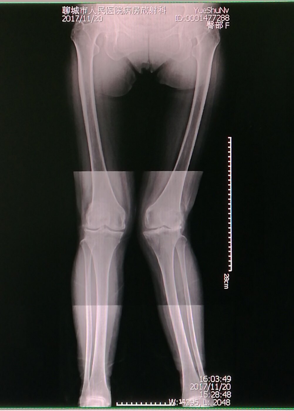 膝外翻畸形tka:股骨外髁滑移截骨技术