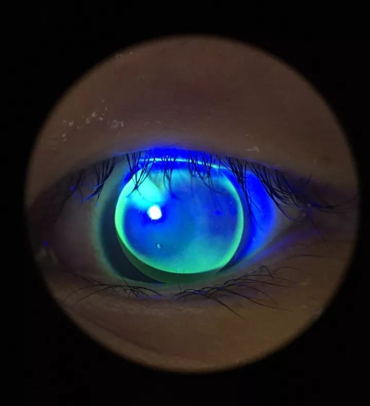 小孩子也要戴隐形眼镜?RGP和OK镜和一般的