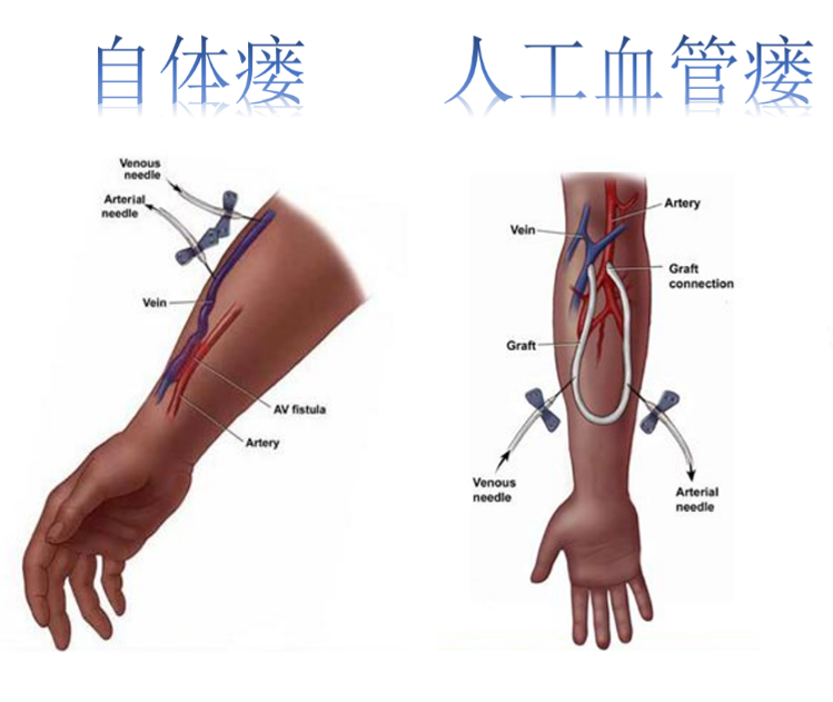 佘大夫谈血液透析通路之3--什么是血液透析内