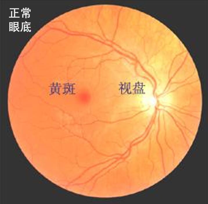 黄斑是我们每个人都有的正常组织,位于眼底视网膜的中心位置,承担了