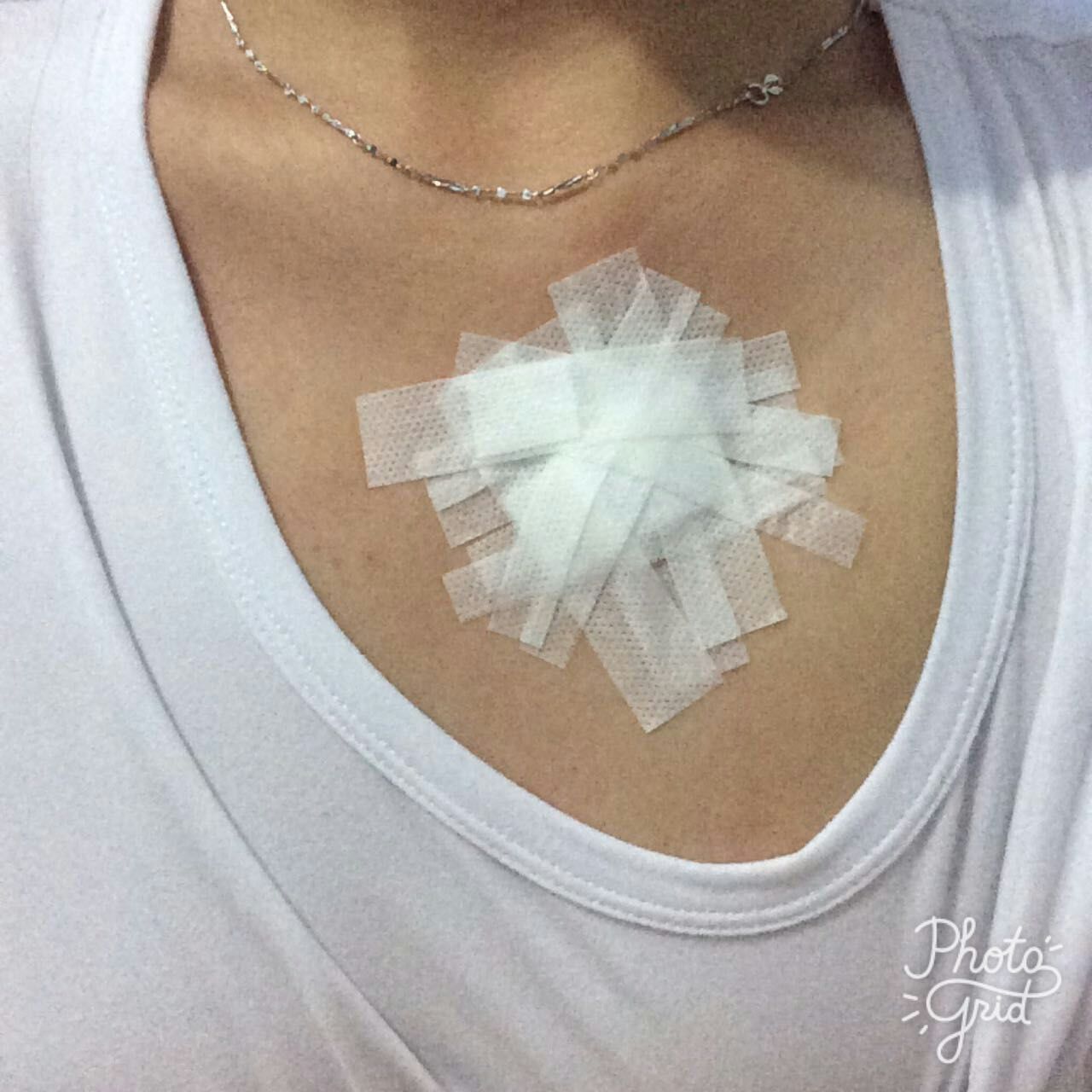 到目前为止,还没有有效治疗瘢痕疙瘩的有效药物,同位素敷贴治疗是较为