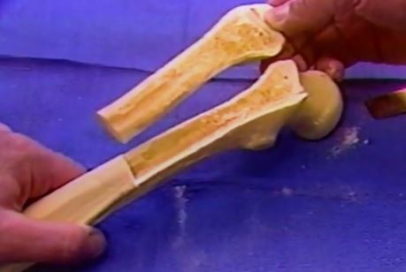 我的人工全髋关节置换翻修手术需要做大粗隆延