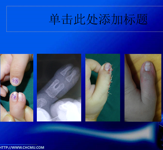 多指(趾)畸形概述(海量手术实例!