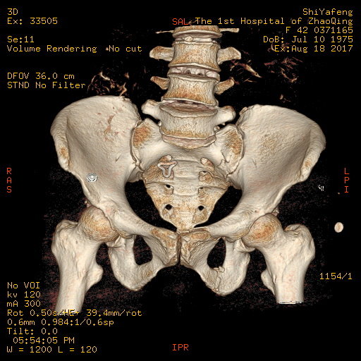 多发伤并骨盆环不稳定骨折的局麻微创固定骶骨