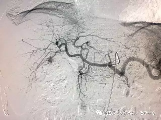 肝癌切除术后发现肝内多发转移--行肝癌介入治