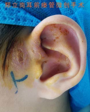 先天性耳前瘘管伴感染的手术治疗45浙江金华