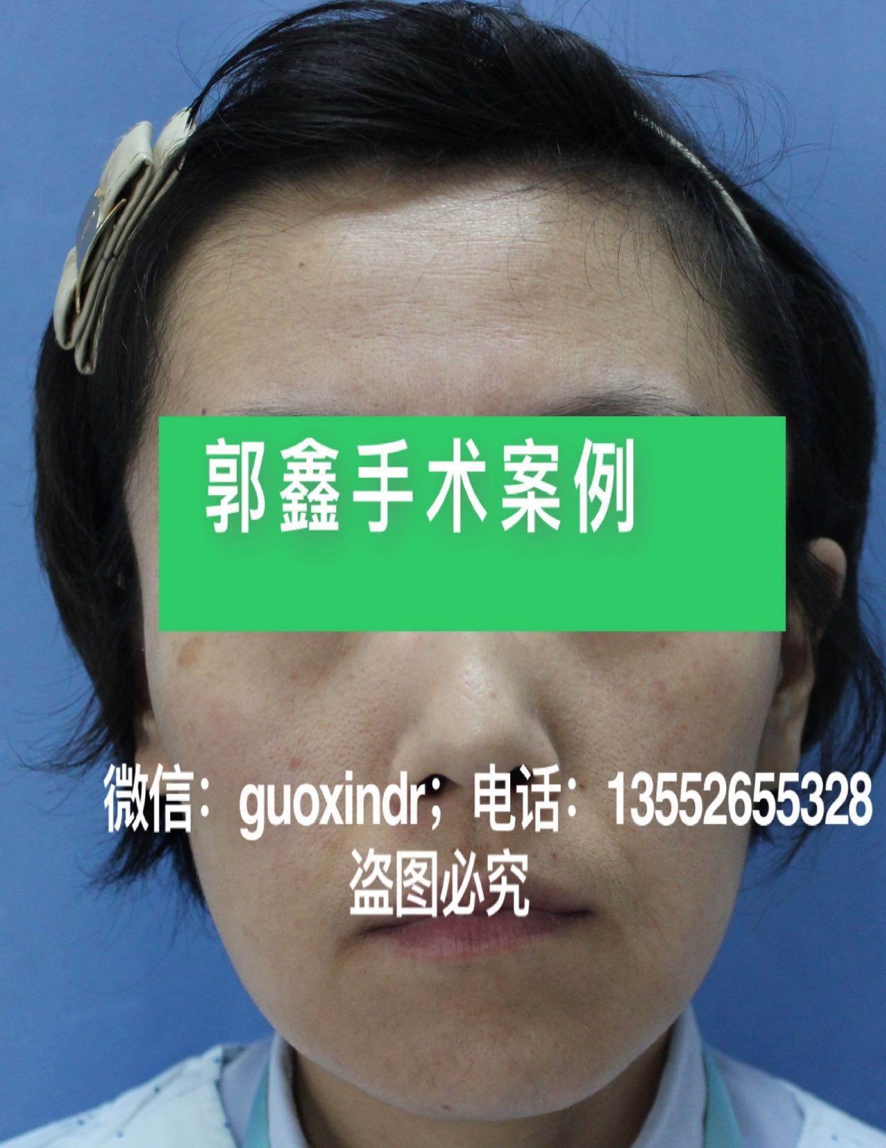 北京面部提升专家代礼先谈32岁,法令纹明显,面颊两侧下垂,显老.面部提升是唯一选择 - 哔哩哔哩