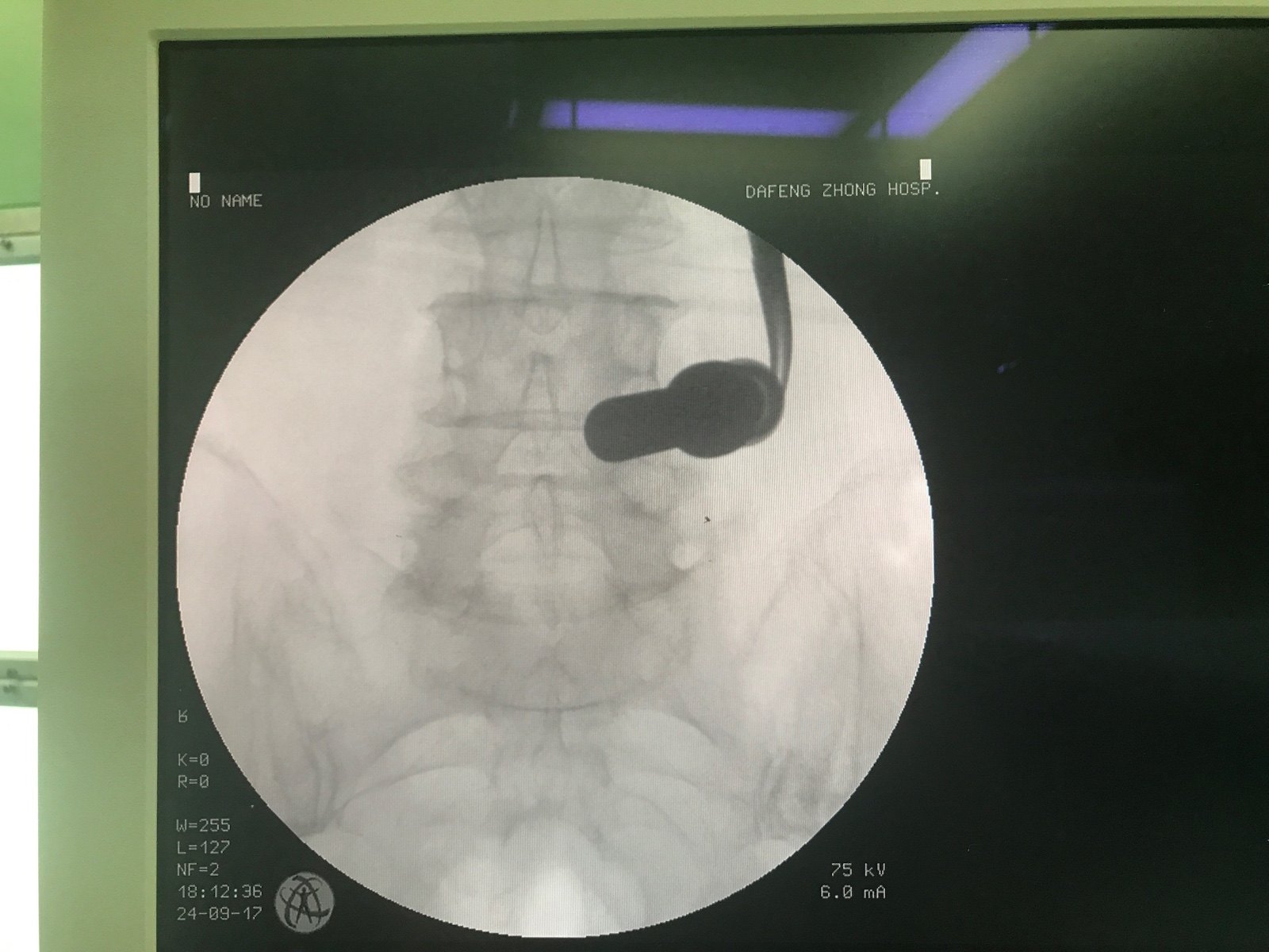 腰椎管狭窄的微创内镜手术:DELTA 大通道椎板