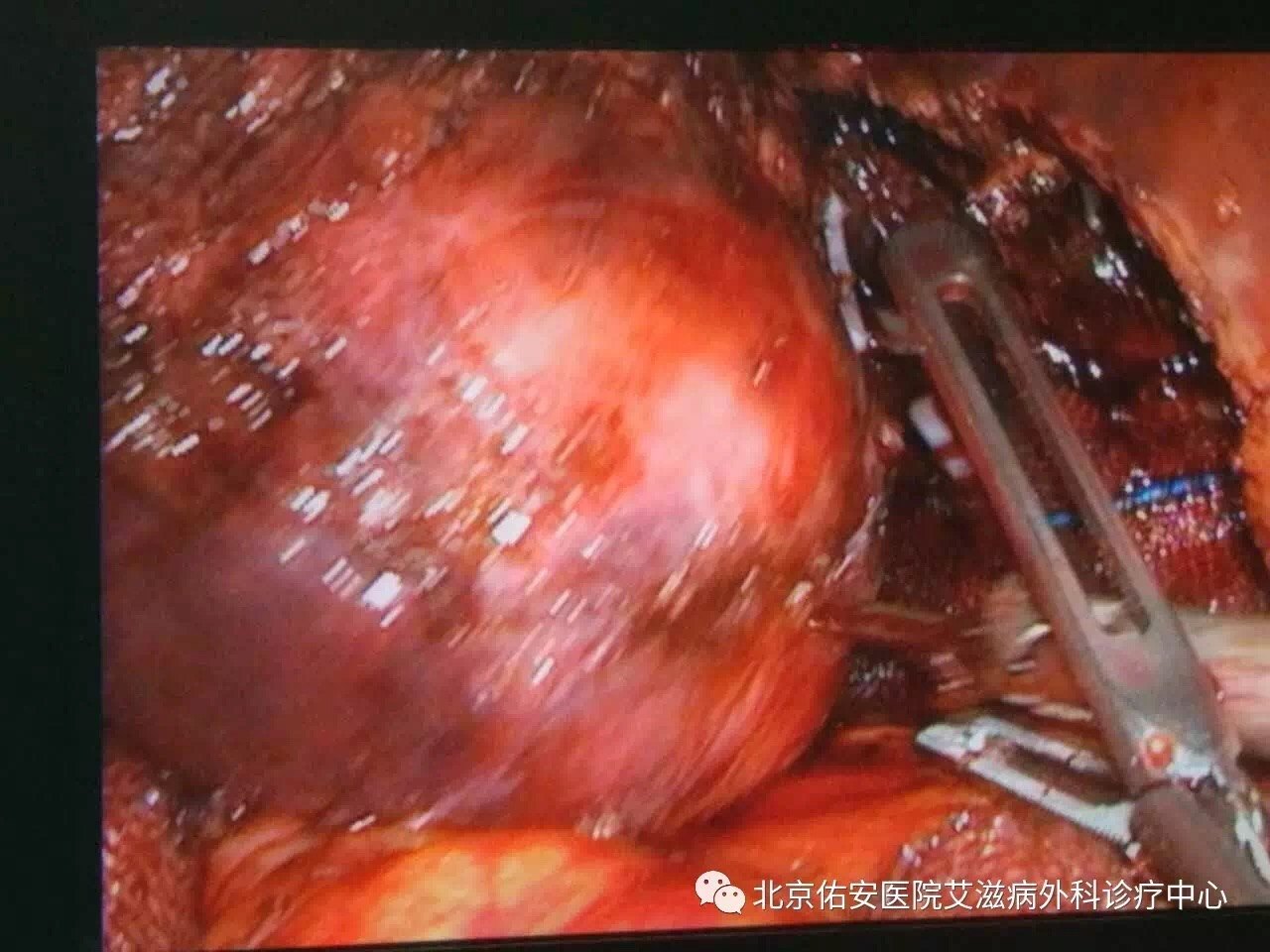 腹腔镜下艾滋病患者肝包虫囊肿切除术