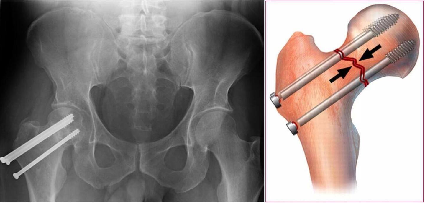 手术方式包括闭合复位内固定(crif),切开复位内固定(orif),人工股骨头