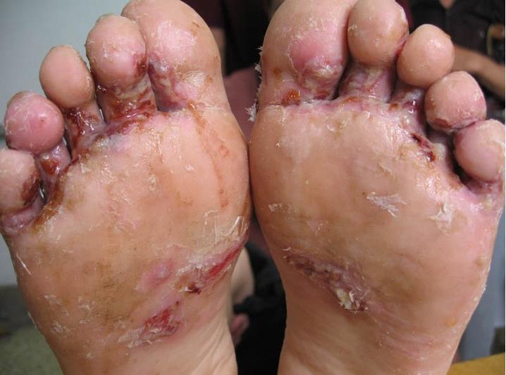 手足癣:手足癣是发生于掌,跖与指,趾间皮肤的浅部真菌感染