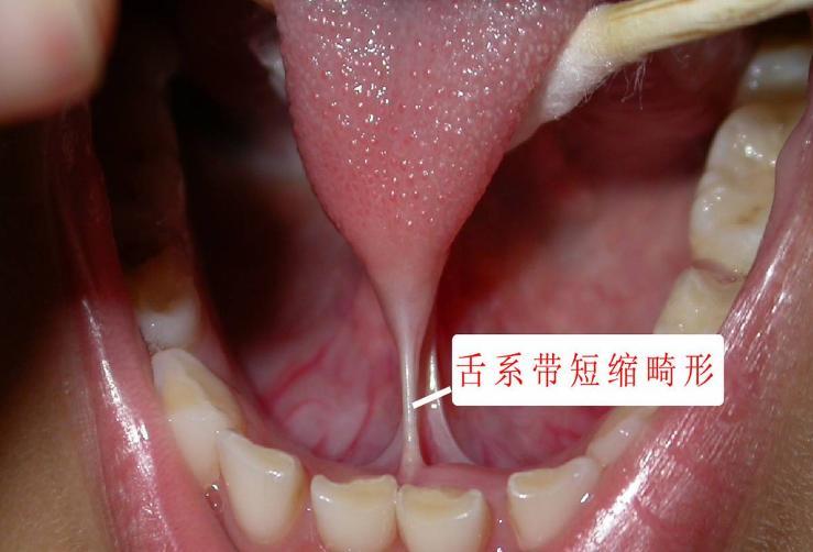 舌系带手术基本知识