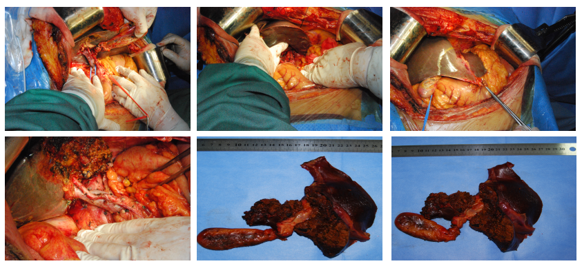 复杂肝门部胆管癌(Ⅳ型)根治性手术切除