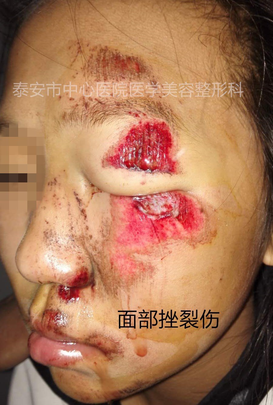面部外伤后综合处理对比